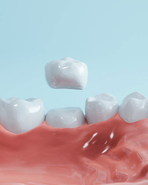 Crowns